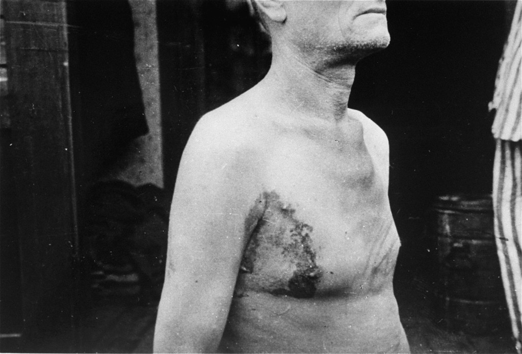 A Soviet prisoner of war, victim of a tuberculosis medical experiment at Neuengamme concentration camp. [LCID: 78764]