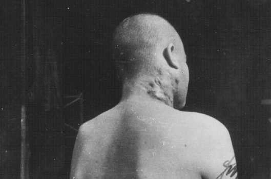 Prisonnier de guerre soviétique, victime d’une expérience médicale sur la tuberculose au camp de concentration de Neuengamme. [LCID: 78755]