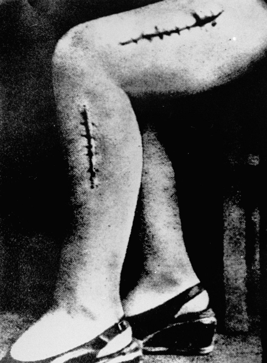 A close view of two large scars on a female survivor’s leg. One scar goes from the knee up the thigh and the other goes from the knee down to the middle of the shin.