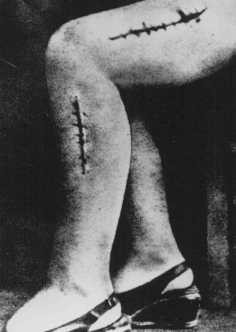 A war crimes investigation photo of the disfigured leg of a survivor from Ravensbrueck, Polish political prisoner Helena Hegier (Rafalska), who was subjected to medical experiments in 1942.
