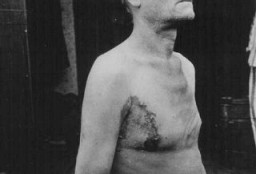 سجين حرب سوفييتي ذهب ضحية مرض السل من التجريبات الطبية بمحتشد الإعتقال بنوينجيم. ألمانيا في أواخر سنة 1944.