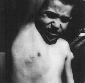 A Jewish child is forced to show the scar left after SS physicians removed his lymph nodes.