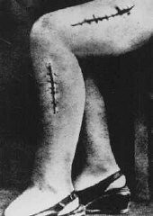 A war crimes investigation photo of the disfigured leg of a survivor from Ravensbrück, Polish political prisoner Helena Hegier (Rafalska), who was subjected to medical experiments in 1942. This photograph was entered as evidence for the prosecution at the Medical Trial in Nuremberg. The disfiguring scars resulted from incisions made by medical personnel that were purposely infected with bacteria, dirt, and slivers of glass.